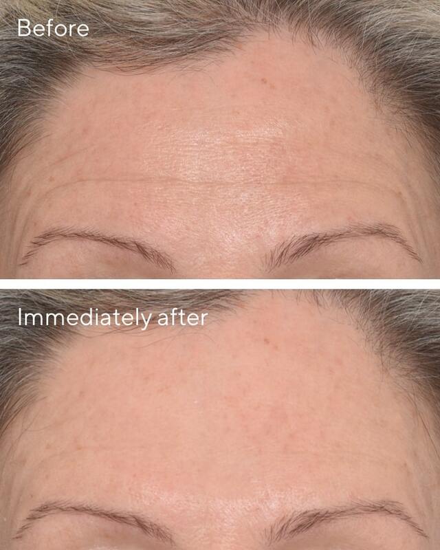 MURAD TARGETED WRINKLE CORRECTOR