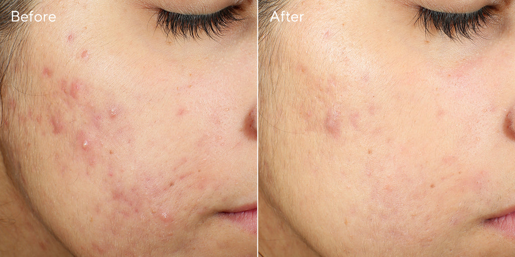 MURAD INVISISCAR RESURFACING TREATMENT